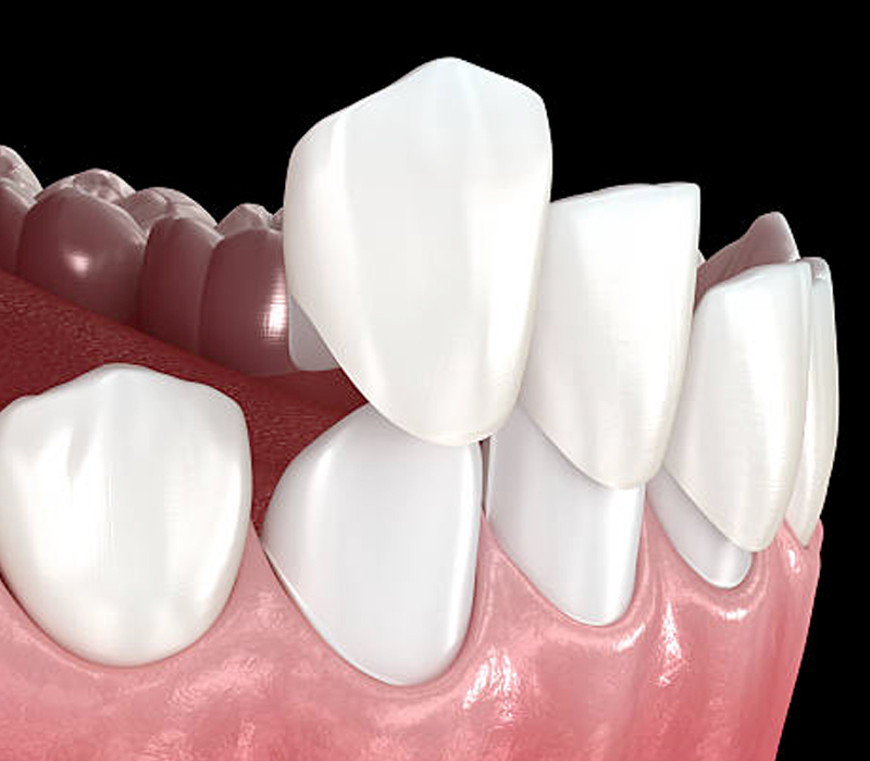 Dental Bonding in Queens Sky Dental Care New York