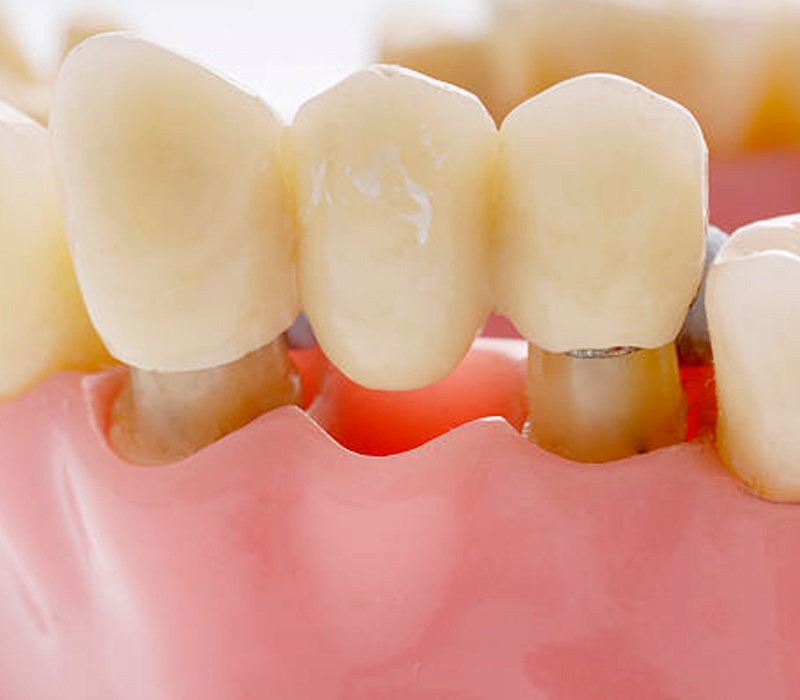 Dental Bridges Sky Dental Care Forest Hills New York