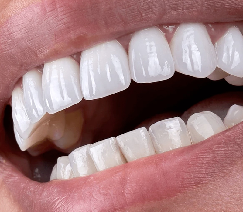 Sky Dental Care Dental Bonding service in Queens NY