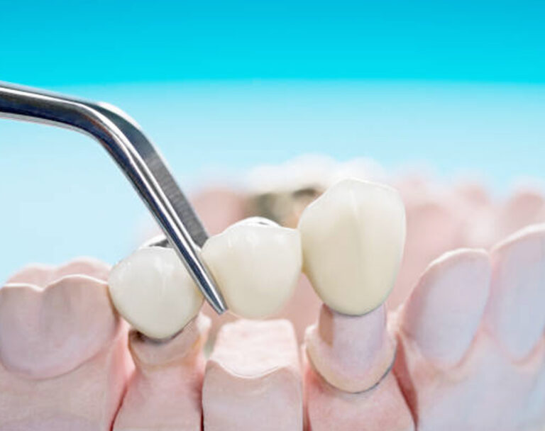 Sky Dental Care Dental Bridges Forest Hills NY