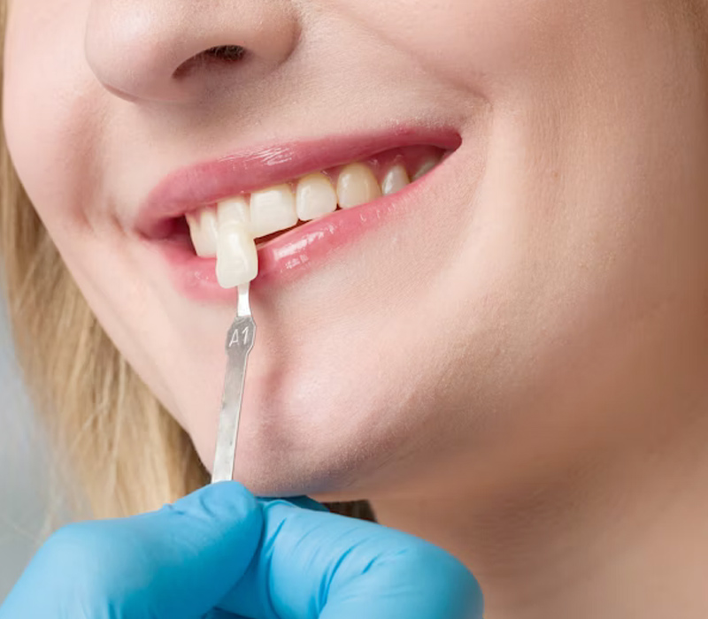 Sky Dental Care Dental Tooth Crown in Queens Forest Hills New York