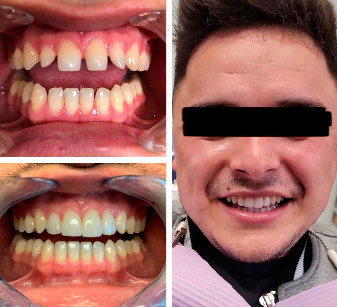 Sky Dental Care Forest Hills New York Before-After-01