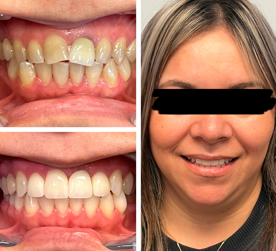 Sky Dental Care Forest Hills New York Before-After-02