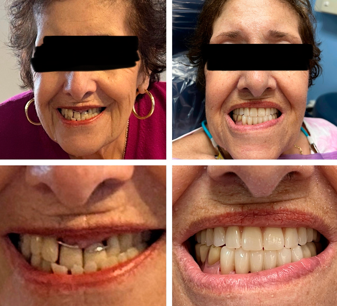 Sky Dental Care Forest Hills New York Before-After-03