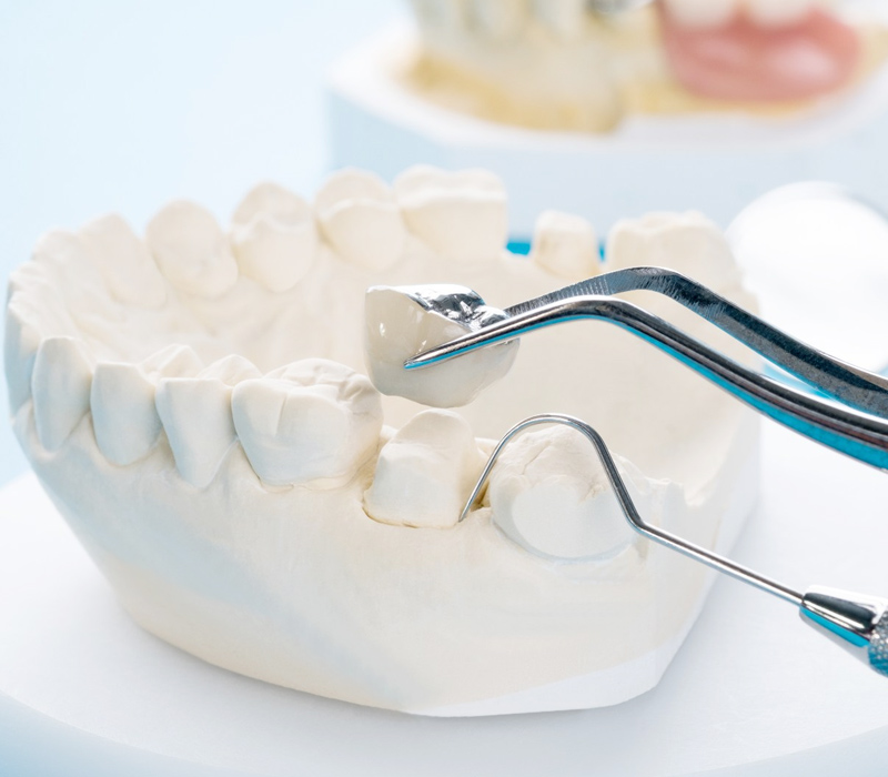 Sky Dental Care Forest Hills New York Dental Crowns