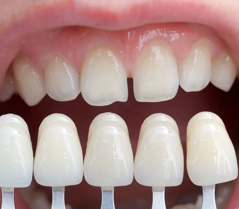 Sky Dental Care Veneers in Forest Hills New York