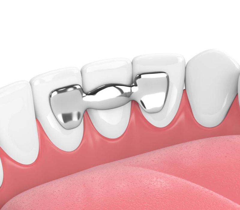 Teeth Bridge Service in Forest Hills Sky Dental Care